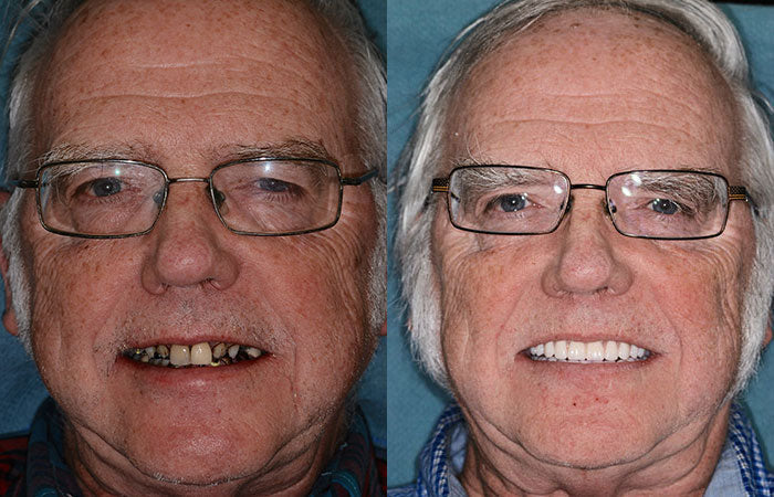 Hidone® --🦷Advanced Customized Full Denture Set🦷 (⏰Limited time discount last 30 minutes⏰)💎💎