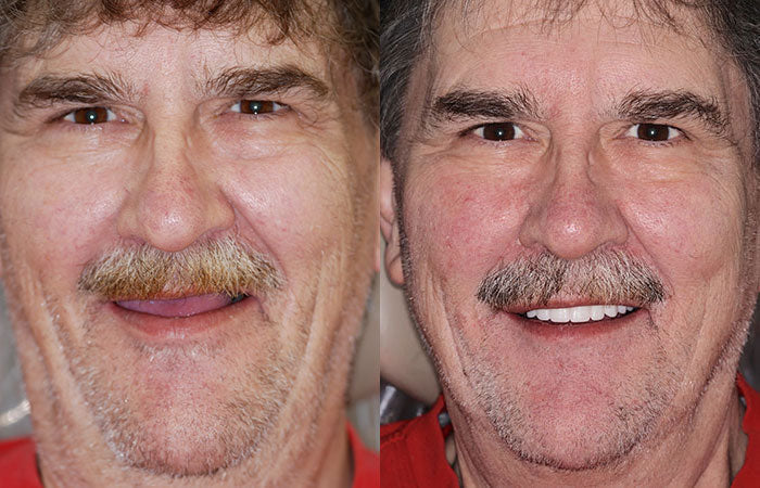 Hidone® --🦷Advanced Customized Full Denture Set🦷 (⏰Limited time discount last 30 minutes⏰)💎💎