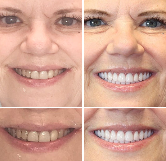 Hidone® --🦷Advanced Customized Full Denture Set🦷 (⏰Limited time discount last 30 minutes⏰)💎💎