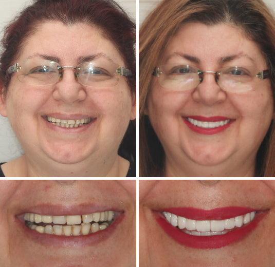 Hidone® --🦷Advanced Customized Full Denture Set🦷 (⏰Limited time discount last 30 minutes⏰)💎💎