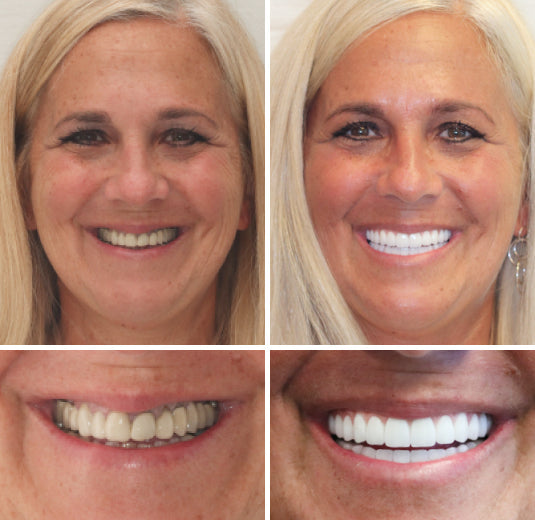 Hidone® --🦷Advanced Customized Full Denture Set🦷 (⏰Limited time discount last 30 minutes⏰)💎💎