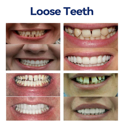 𝐁𝐢𝐤𝐞𝐧𝐝𝐚®-🦷𝐀𝐝𝐯𝐚𝐧𝐜𝐞𝐝 𝐂𝐮𝐬𝐭𝐨𝐦𝐢𝐳𝐞𝐝 𝐅𝐮𝐥𝐥 𝐃𝐞𝐧𝐭𝐮𝐫𝐞 𝐒𝐞𝐭🦷 (⏰Limited time discount last 30 minutes⏰)🍁💖