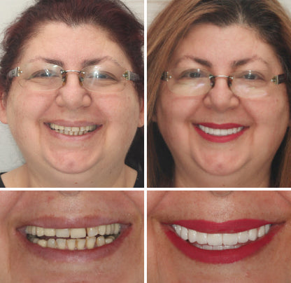 Hidone® --🦷Advanced Customized Full Denture Set🦷 (⏰Limited time discount last 30 minutes⏰)💎💎