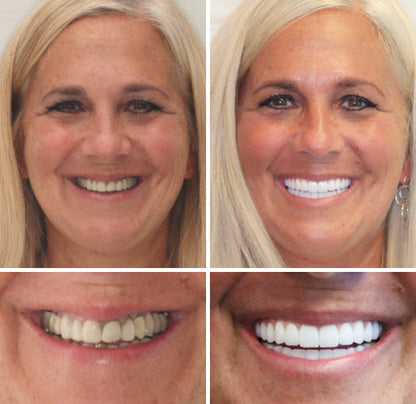 Hidone® --🦷Advanced Customized Full Denture Set🦷 (⏰Limited time discount last 30 minutes⏰)💎💎